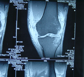 Mri Bone